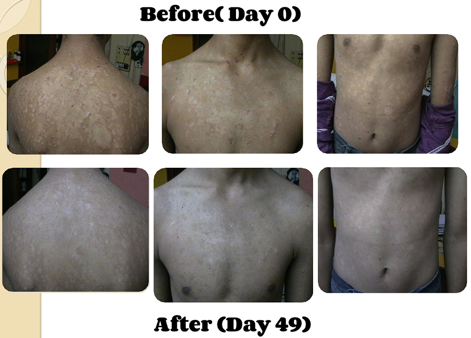 Case 1: Guttate Psoriasis - 14 years